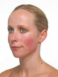 rosacea